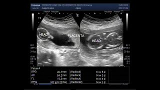 Ultrasound Video showing a miscarriage in the second trimester [upl. by Esej]