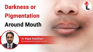 Darkness or Pigmentation Around Mouth  Darkening Around Mouth Causes  Treatment  Dermatologist [upl. by Eigna]