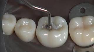 Class I Amalgam Preparation amp Restoration  Operative Dentistry [upl. by Hinman]