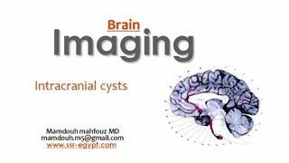 Imaging intracerebral cysts DRE Prof Mamdouh Mahfouz [upl. by Beverlee]