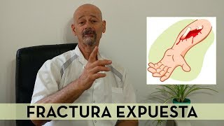 Fractura expuesta  Tratamiento [upl. by Hadden]