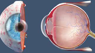 CATARACT Causes Signs and Symptoms Diagnosis and Treatment [upl. by Palocz]