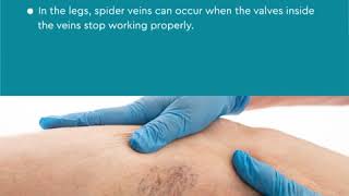 Medical Clinic How To Remove Varicose Veins explained  Vein Treatment Center New York 10017 [upl. by Kaylil679]