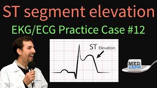 ST Elevation  EKG  ECG Interpretation Case 12 STEMI MI ACS [upl. by Okime284]