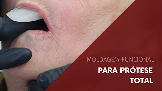 Moldagem Funcional para Prótese Total [upl. by Grindlay335]