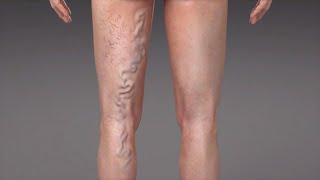 Stages of Varicose Veins [upl. by Vod130]