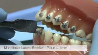 American Orthodontics Alexander LTS Brackets  Bracket Placement Video [upl. by Lrub829]