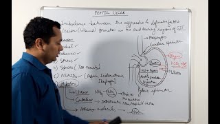 Part1 Ulcer Pathophysiology Gastric peptic duodenal ulcer [upl. by Luciano]