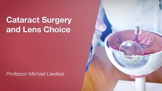 Cataract Surgery and Lens Choice [upl. by Kcaj]