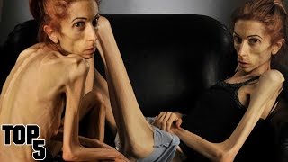 Top 5 Skinniest People In The World [upl. by Eendys]