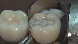 Class II Amalgam Preparation amp Restoration  Operative Dentistry [upl. by Aerdnaeel]