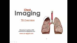 TB imaging overview DRE Prof Mamdouh Mahfouz [upl. by Drislane]