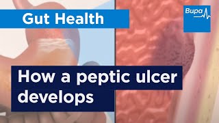 How a peptic ulcer develops  Bupa Health [upl. by Arreit991]