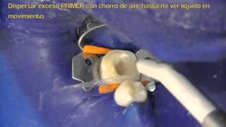 Como cementar incrustación dental overlay composite o cerómeroTratamiento dental Parte II [upl. by Allicsirp]