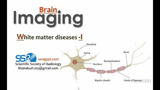 White matter diseases DRE  Prof Mamdouh Mahfouz [upl. by Danyluk]