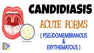 CANDIDIASIS  ACUTE FORMS  PSEUDOMEMBRANOUS amp ERYTHEMATOUS [upl. by Marlea]