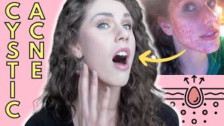 What Is Cystic Acne Causes Treatment  Cassandra Bankson [upl. by Branden544]