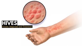 HIVES Causes Signs and Symptoms Diagnosis and Treatment [upl. by Terraj]