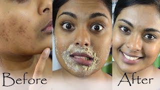 How To Get Rid Of Hyperpigmentation Dark Upper Lip Dark Spots amp Acne Scars Naturally At Home [upl. by Greggs]