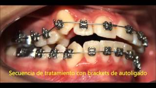 CASO CLINICO Brackets Autoligado y Elasticos [upl. by Lerrad]