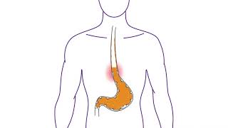 Nexium Control®  What is Heartburn [upl. by Ojyllek31]