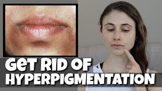 GET RID OF HYPERPIGMENTATION AROUND THE MOUTH DR DRAY [upl. by Mount]