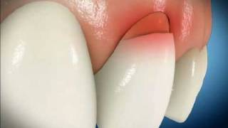 Bonding Tooth Brush Abrasion Repair [upl. by Shermy]