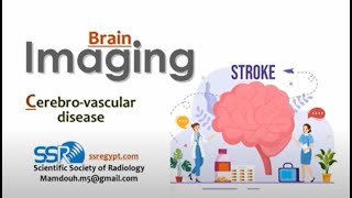 Cerebrovascular disease DRE  Prof Mamdouh Mahfouz [upl. by Ennairam]