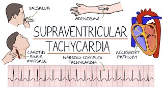 Understanding Supraventricular Tachycardia SVT [upl. by Byrle]