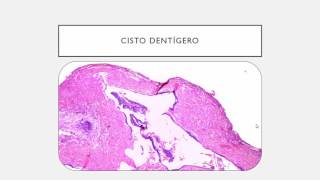 10  CISTOS ODONTOGÊNICOS [upl. by Airahcaz]