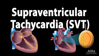 Supraventricular Tachycardia SVT PSVT Animation [upl. by Langham]