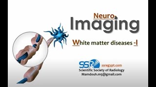 White matter diseases DRE  Prof Mamdouh Mahfouz [upl. by Nirrej]