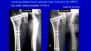 Complex Proximal Femur Fractures [upl. by Shem951]