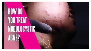 How Do You Treat Nodulocystic Acne  Houston Dermatology [upl. by Ak]