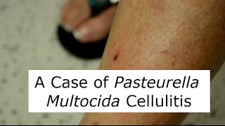 P Multocida Cat Scratch Infection [upl. by Ben11]