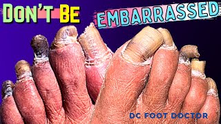 Dont Be Embarrassed Toenails Trimmed After Many Years of Being Embarrassed About Her Feet [upl. by Elsy]