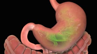 Stomach Ulcer  Nucleus Health [upl. by Erbe]