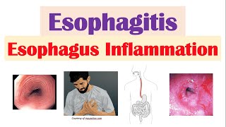 Esophagitis Esophagus Inflammation Causes Risk Factors Signs and Symptoms Diagnosis Treatment [upl. by Thanasi]