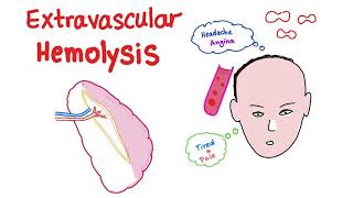 Extravascular Hemolysis [upl. by Maharg53]