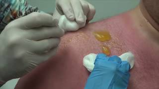 Popping Big Sun Burn Blisters with Dr G [upl. by Titania228]