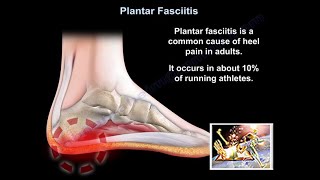 Plantar Fasciitis Pain Relief Treatments  Ask Doctor Jo [upl. by Denison]