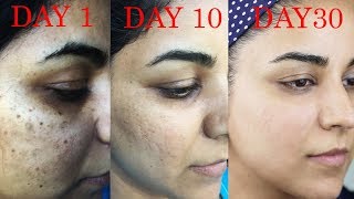 How I Got Rid of Dark Scars Hyperpigmentation PimplesAcne [upl. by Roosevelt]