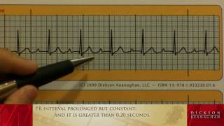 EKG Training An Introduction to Bradycardia  Heart Blocks Part 1 of 3 [upl. by Reave120]