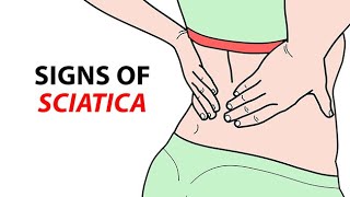 Signs of Sciatica [upl. by Engle]