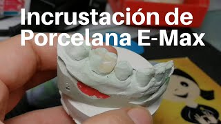 INCRUSTACIÓN Dental de Porcelana👅 EMax Onlay dentaltip [upl. by Zehcnas769]