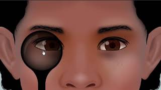 What Is Esotropia And Can Vision Therapy Help [upl. by Eimma]