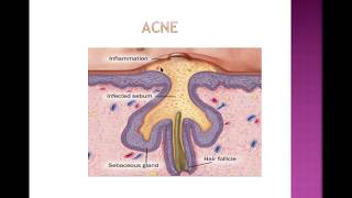 Acne vulgaris [upl. by Pompei]