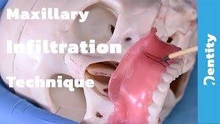 Maxillary Infiltration Technique  شرح عملي [upl. by Alleyne612]