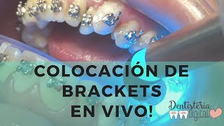 Colocación de Brackets en VIVO  Putting on Braces  LIVE [upl. by Ikkim]