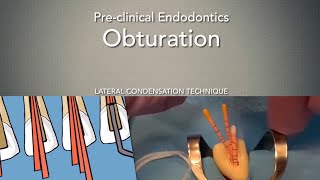 Obturation Lateral Condensation Technique [upl. by Jemimah]